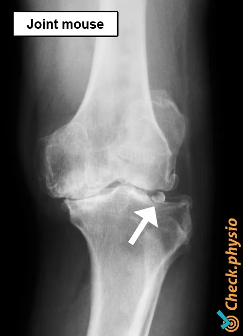 corpus-liberum-knee-x-ray.jpg